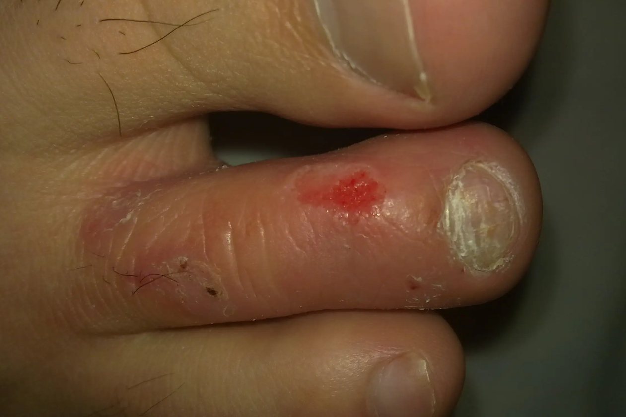 脚抓破皮感染了红肿图片