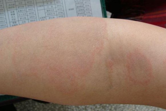 远心性环状红斑