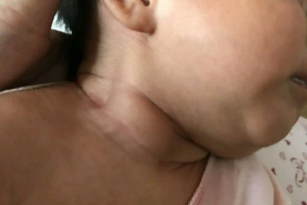 斜颈