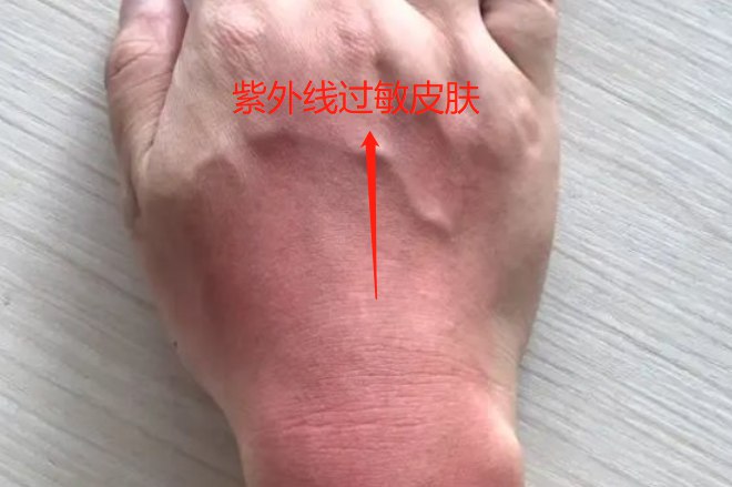 紫外线过敏图片