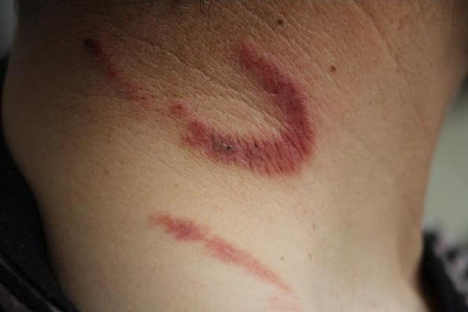 隐翅虫皮炎留下红印子