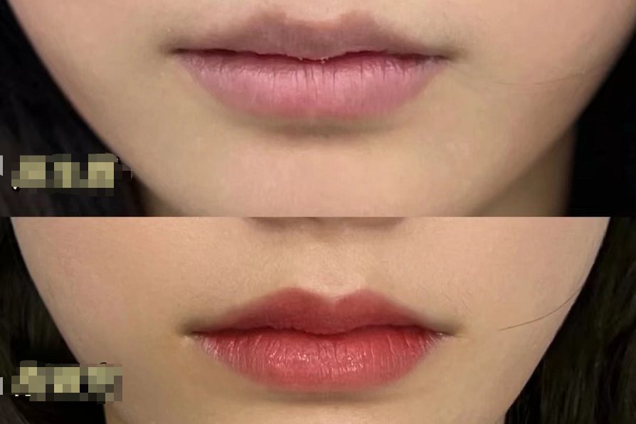 纹唇恢复后效果图