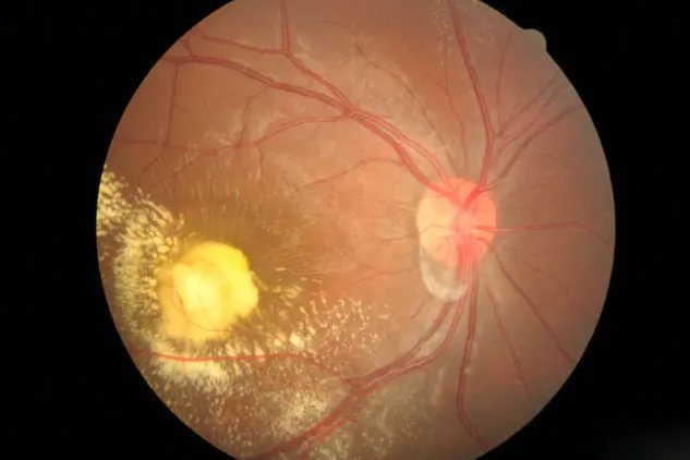 眼底早期病变图片