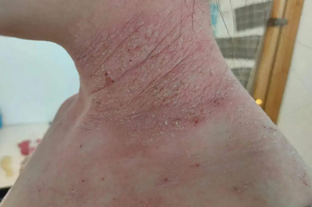 脖子过敏性湿疹