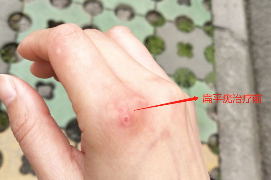 扁平疣治疗前图片