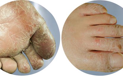 角化增厚型足癣症状