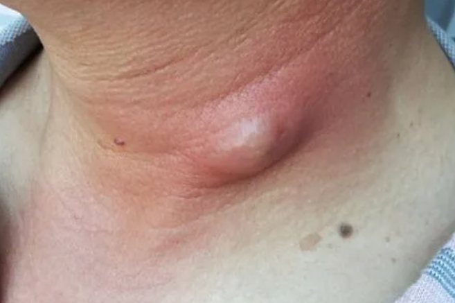 皮脂腺囊肿