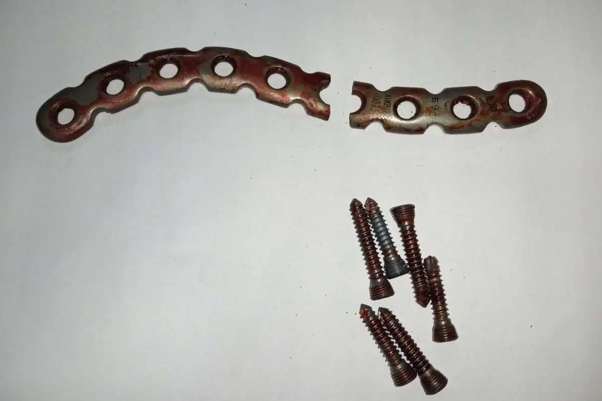 锁骨骨折钢板图片