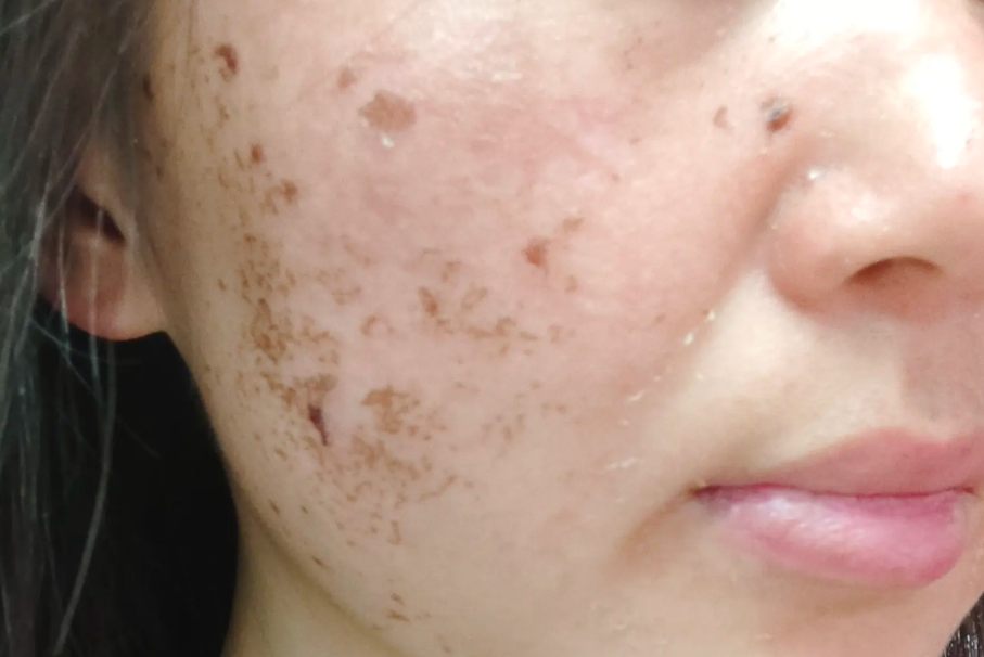 色素提取祛斑结痂