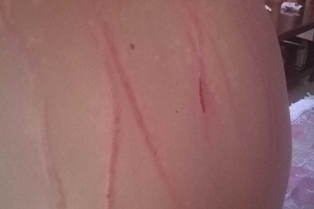 身上被指甲抓伤图片