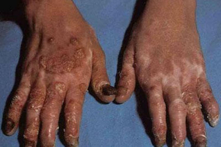 关节病型银屑病