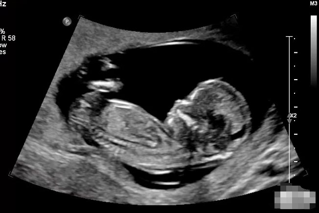 三个月胎儿图彩超