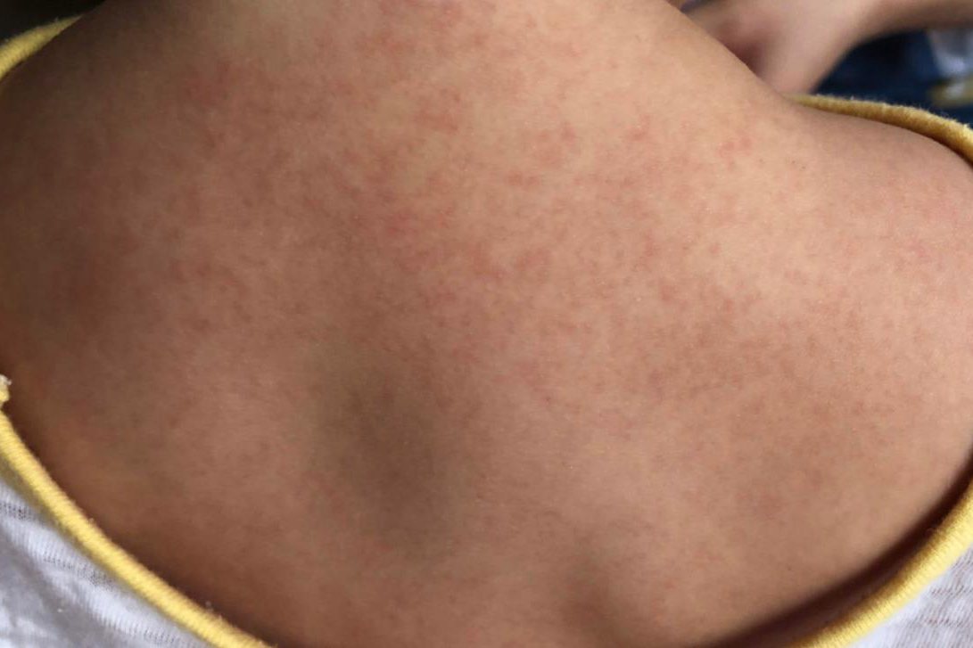 打麻腮风出的疹子