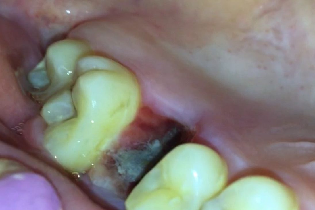 拔牙4天后的血凝块