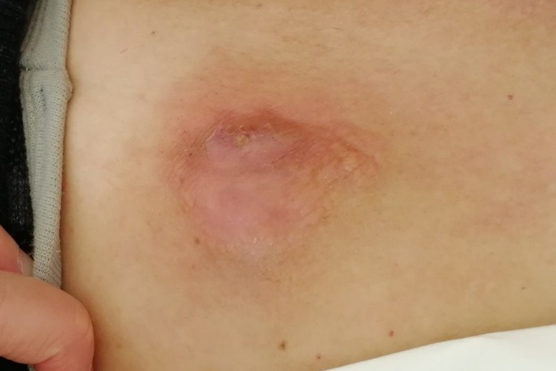 输液港局部发生感染