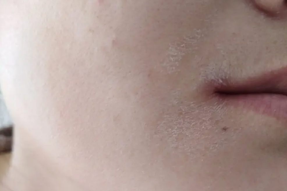 下巴周围干燥起皮图片
