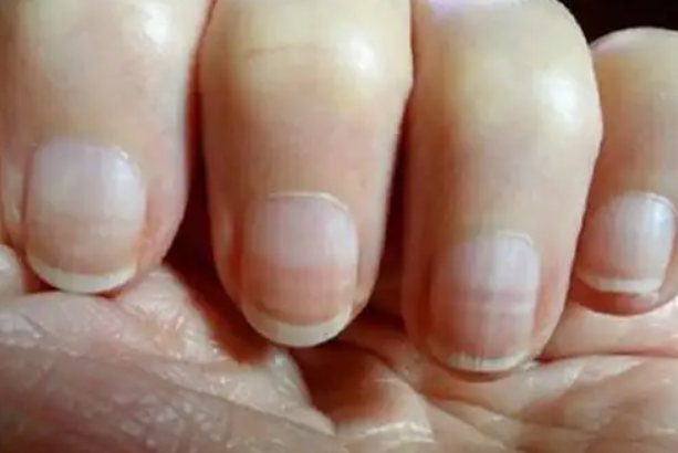 林赛氏指甲早期