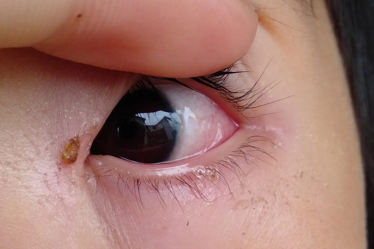 过敏性结膜炎
