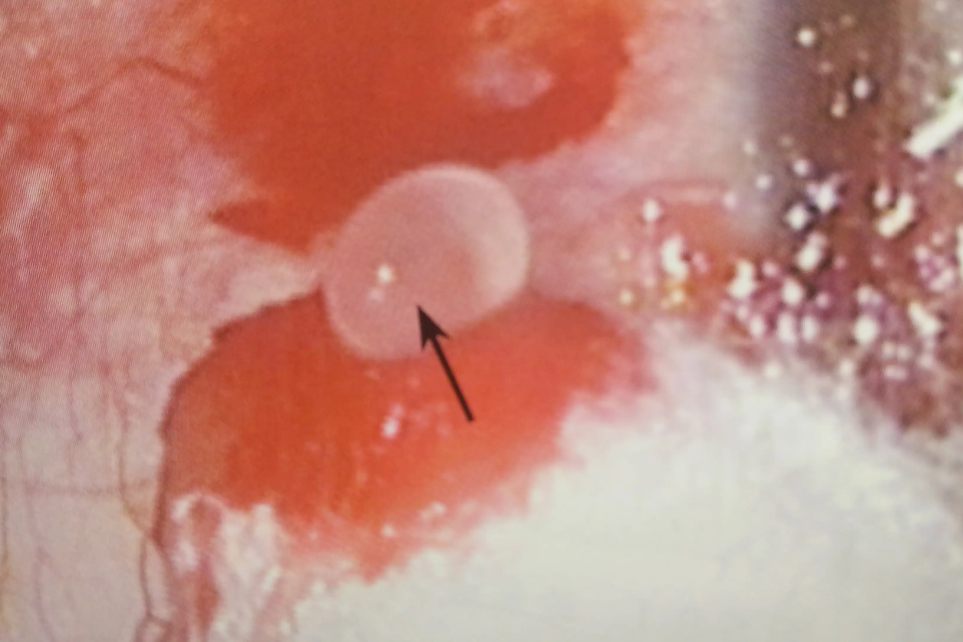 结膜淋巴管堵塞起水泡