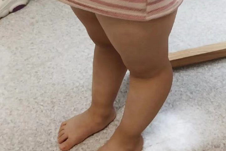膝反张