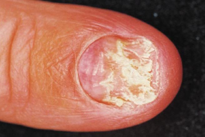 白色念珠菌甲癣