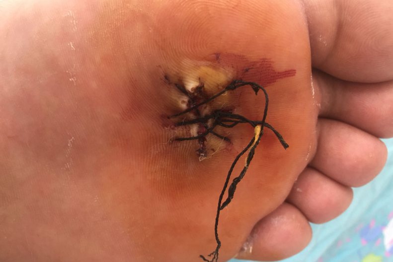 跖疣手术切除后的照片