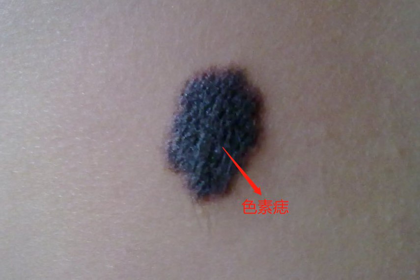 色素痣