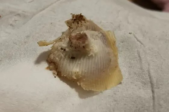 寻常疣挖出来的根