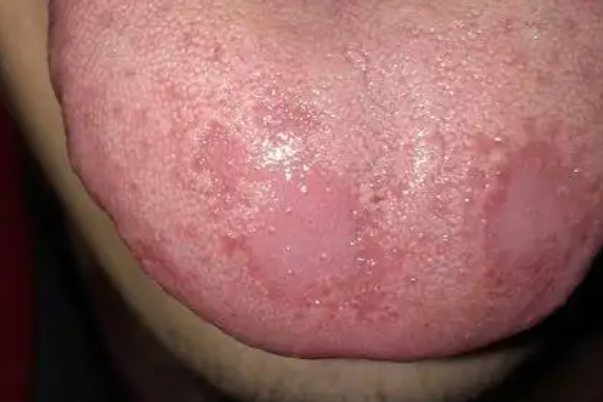 舌头烫伤后图片