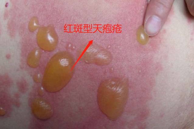 红斑型天疱疮
