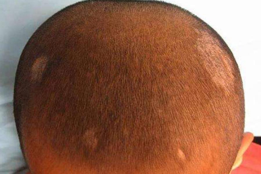 白癣病的图片.jpg】