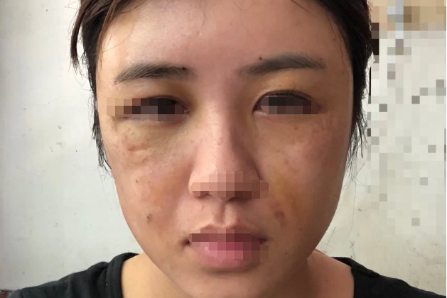 打肉毒素后遗症图片