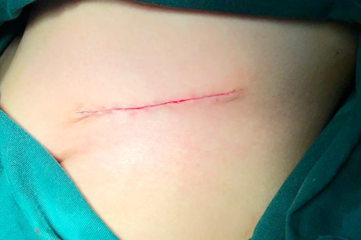 美容针伤口缝合