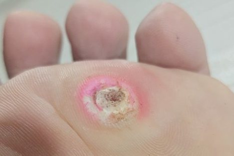 鸡眼治疗第三天