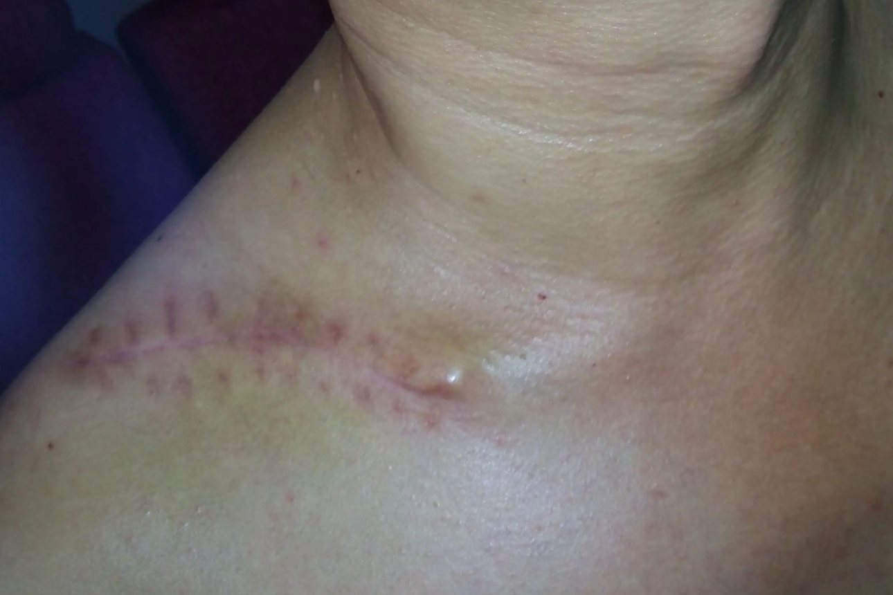 锁骨骨折手术疤痕