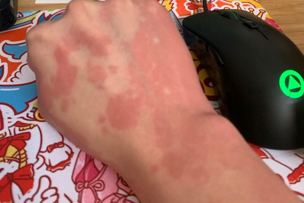 酒后皮肤红白斑