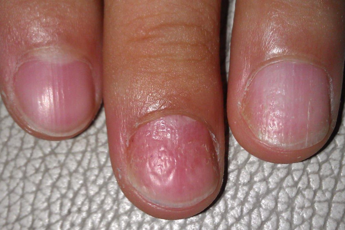 指甲凹陷