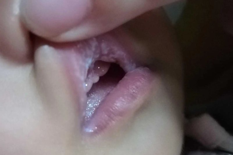 人的嘴唇真菌感染