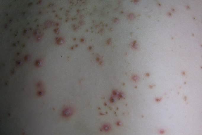 马拉色菌毛囊炎