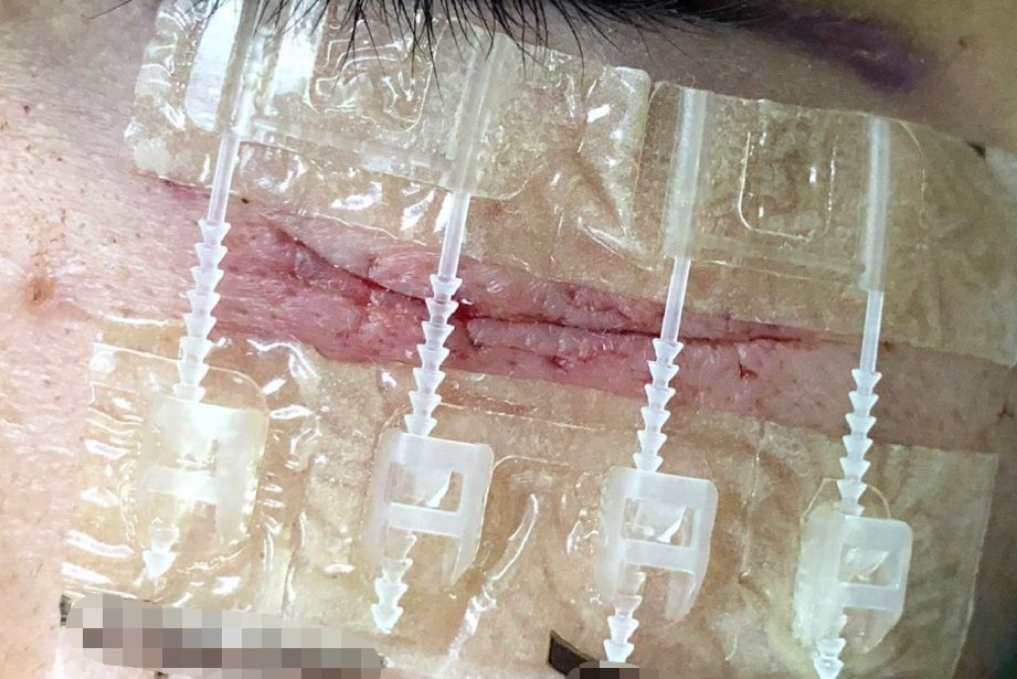 用美容胶粘的伤口