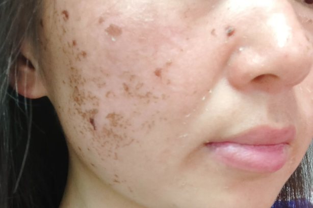 点斑之后几天掉痂图片