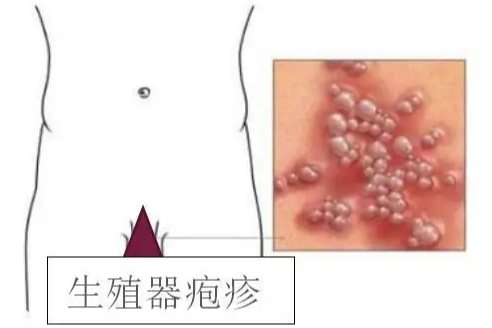 生殖器感染
