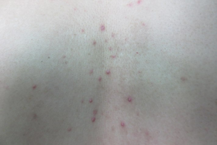 背部马拉色菌毛囊炎