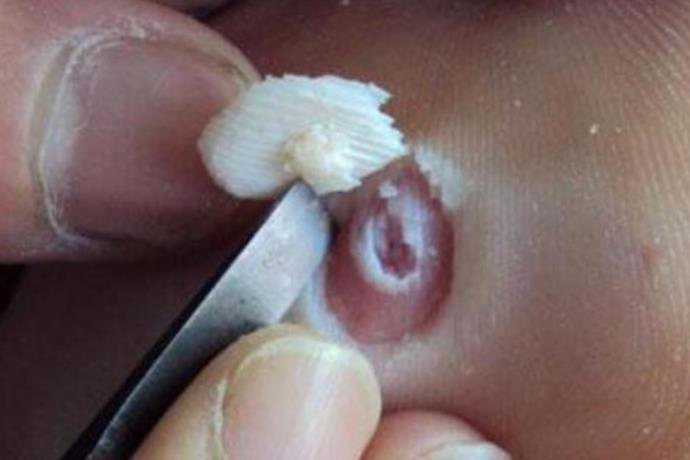 鸡眼被取出来的样子