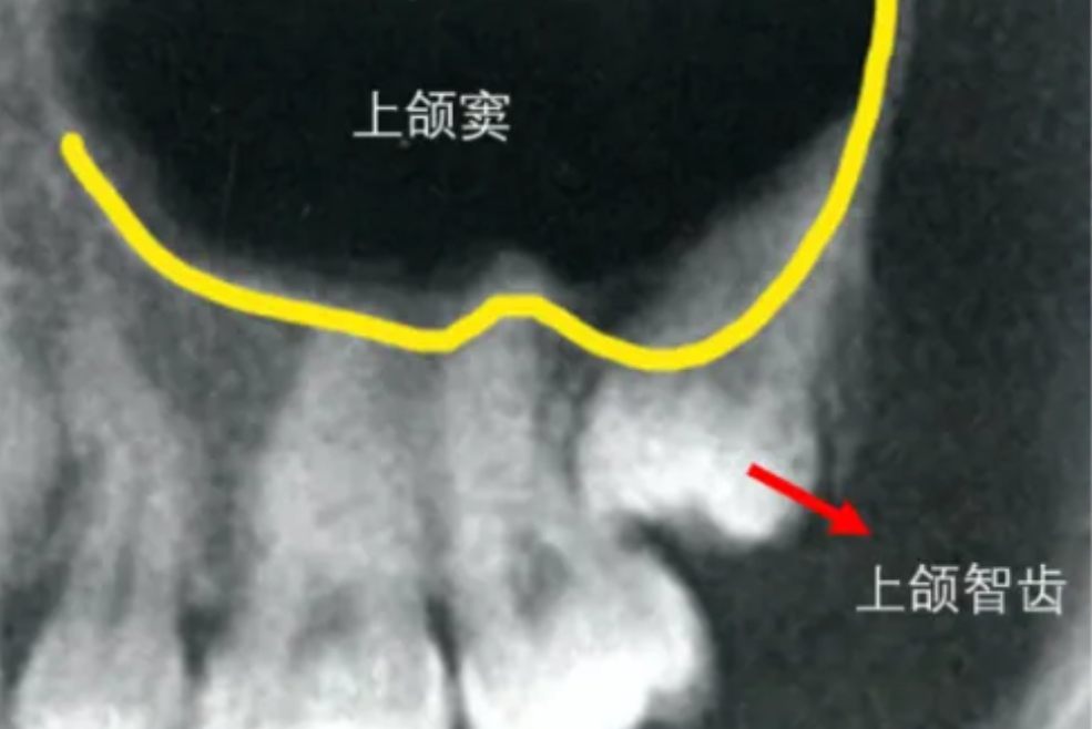 上智齿太靠近上颌窦