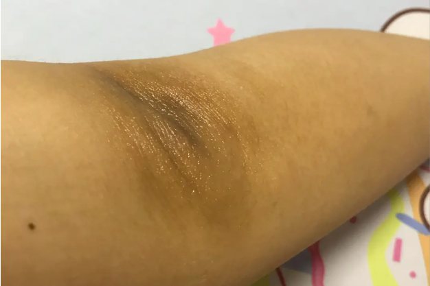 缺乏维生素b12