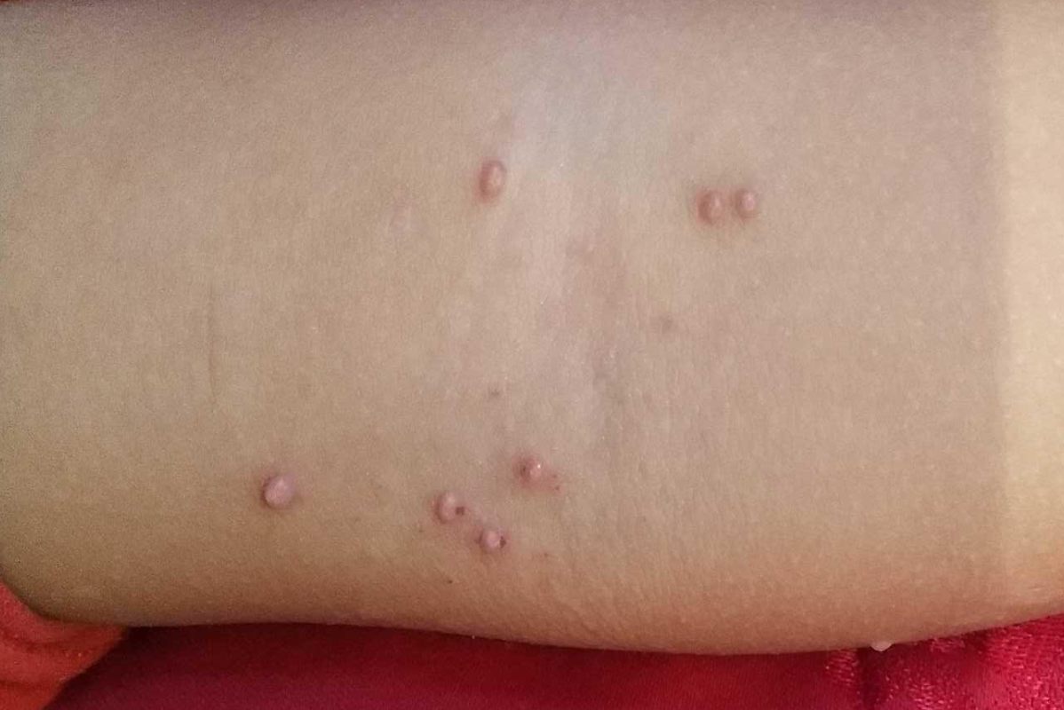 传染性软疣并感染性毛囊炎