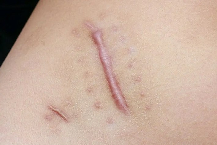 阑尾炎开腹手术疤痕