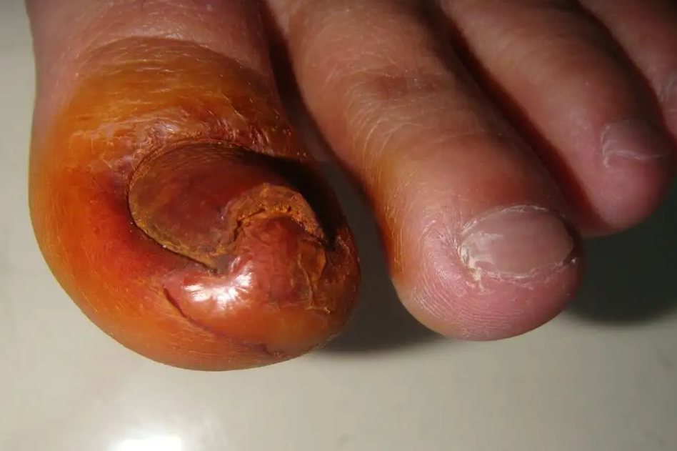 Ⅳ期（慢性嵌甲型甲沟炎形成期）