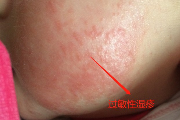 过敏性湿疹